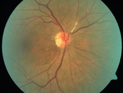 Asymptomatic Hollenhorst Plaque - Cholesterol Embolis
71-year-old woman is not noticing any vision change.  She does take pressure-lowering drops for glaucoma, both Timolol and Xalatan.

VISUAL ACUITY:  Vision OD is 20/30, OS is 20/16
