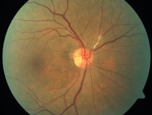 Asymptomatic Hollenhorst Plaque - Cholesterol Embolis
71-year-old woman is not noticing any vision change.  She does take pressure-lowering drops for glaucoma, both Timolol and Xalatan.

VISUAL ACUITY:  Vision OD is 20/30, OS is 20/16
