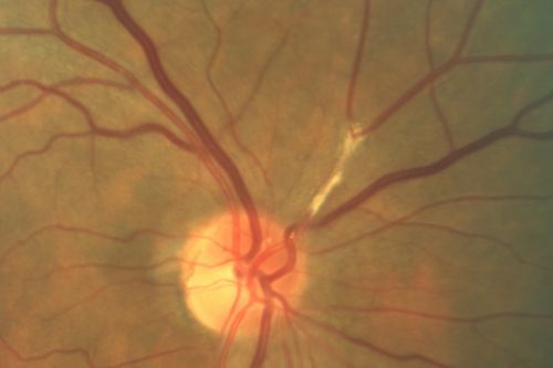 Asymptomatic Hollenhorst Plaque - Cholesterol Embolis
71-year-old woman is not noticing any vision change.  She does take pressure-lowering drops for glaucoma, both Timolol and Xalatan.

VISUAL ACUITY:  Vision OD is 20/30, OS is 20/16
