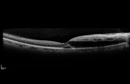 Hypertensive Retinopathy - BP 240 / 130 mmHg - Grade 4
71 year old woman who claims to be asymptomatic with decreased vision, macular edema, cotton wool spots, subretinal fluid and optic nerve edema
