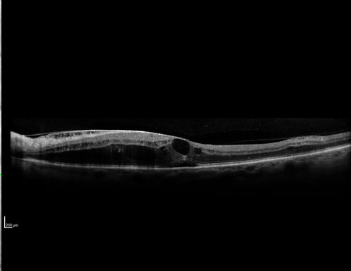 Hypertensive Retinopathy - BP 240 / 130 mmHg - Grade 4
71 year old woman who claims to be asymptomatic with decreased vision, macular edema, cotton wool spots, subretinal fluid and optic nerve edema
