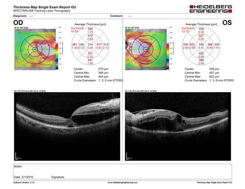 Hypertensive Retinopathy - BP 240 / 130 mmHg - Grade 4
71 year old woman who claims to be asymptomatic with decreased vision, macular edema, cotton wool spots, subretinal fluid and optic nerve edema

