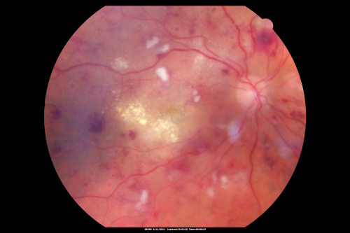 Malignany Hypertension - BP 250/130 - Vision 1/200 in each eye - Diabetic
68-year-old woman poor vision in both eyes for the last few years.  She is diabetic since 1989.  Her blood pressure has been very high.  She was in the hospital Friday.  Her blood pressure during that visit was 250/130 and her blood pressure in your office she reports was somewhere around the same.  I just checked her blood pressure at the beginning of my visit and it was 200/120 in her right arm sitting.  Her vision is poor enough that she can barely see to walk around.  She has also been feeling nauseous 
