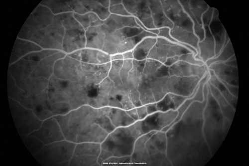 Malignany Hypertension - BP 250/130 - Vision 1/200 in each eye - Diabetic
68-year-old woman poor vision in both eyes for the last few years.  She is diabetic since 1989.  Her blood pressure has been very high.  She was in the hospital Friday.  Her blood pressure during that visit was 250/130 and her blood pressure in your office she reports was somewhere around the same.  I just checked her blood pressure at the beginning of my visit and it was 200/120 in her right arm sitting.  Her vision is poor enough that she can barely see to walk around.  She has also been feeling nauseous 
