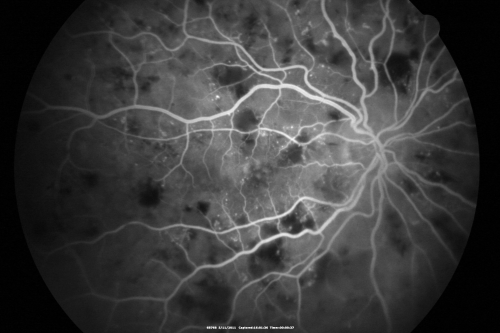 Malignany Hypertension - BP 250/130 - Vision 1/200 in each eye - Diabetic
68-year-old woman poor vision in both eyes for the last few years.  She is diabetic since 1989.  Her blood pressure has been very high.  She was in the hospital Friday.  Her blood pressure during that visit was 250/130 and her blood pressure in your office she reports was somewhere around the same.  I just checked her blood pressure at the beginning of my visit and it was 200/120 in her right arm sitting.  Her vision is poor enough that she can barely see to walk around.  She has also been feeling nauseous 
