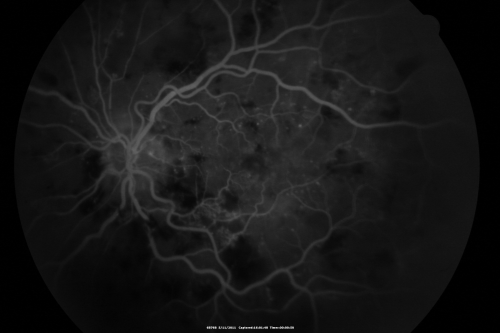 Malignany Hypertension - BP 250/130 - Vision 1/200 in each eye - Diabetic
68-year-old woman poor vision in both eyes for the last few years.  She is diabetic since 1989.  Her blood pressure has been very high.  She was in the hospital Friday.  Her blood pressure during that visit was 250/130 and her blood pressure in your office she reports was somewhere around the same.  I just checked her blood pressure at the beginning of my visit and it was 200/120 in her right arm sitting.  Her vision is poor enough that she can barely see to walk around.  She has also been feeling nauseous 
