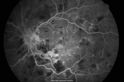 Malignany Hypertension - BP 250/130 - Vision 1/200 in each eye - Diabetic
68-year-old woman poor vision in both eyes for the last few years.  She is diabetic since 1989.  Her blood pressure has been very high.  She was in the hospital Friday.  Her blood pressure during that visit was 250/130 and her blood pressure in your office she reports was somewhere around the same.  I just checked her blood pressure at the beginning of my visit and it was 200/120 in her right arm sitting.  Her vision is poor enough that she can barely see to walk around.  She has also been feeling nauseous 
