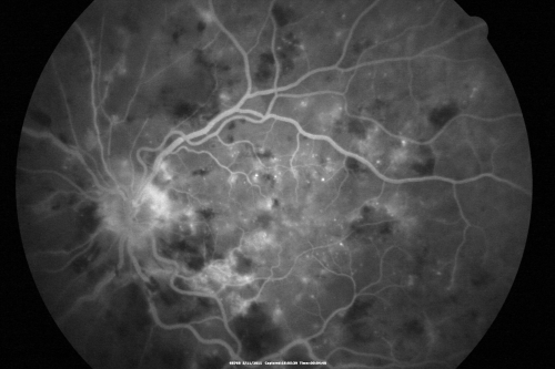 Malignany Hypertension - BP 250/130 - Vision 1/200 in each eye - Diabetic
68-year-old woman poor vision in both eyes for the last few years.  She is diabetic since 1989.  Her blood pressure has been very high.  She was in the hospital Friday.  Her blood pressure during that visit was 250/130 and her blood pressure in your office she reports was somewhere around the same.  I just checked her blood pressure at the beginning of my visit and it was 200/120 in her right arm sitting.  Her vision is poor enough that she can barely see to walk around.  She has also been feeling nauseous 
