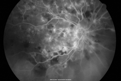 Malignany Hypertension - BP 250/130 - Vision 1/200 in each eye - Diabetic
68-year-old woman poor vision in both eyes for the last few years.  She is diabetic since 1989.  Her blood pressure has been very high.  She was in the hospital Friday.  Her blood pressure during that visit was 250/130 and her blood pressure in your office she reports was somewhere around the same.  I just checked her blood pressure at the beginning of my visit and it was 200/120 in her right arm sitting.  Her vision is poor enough that she can barely see to walk around.  She has also been feeling nauseous 
