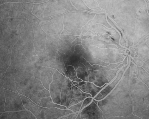 Hypertensive Retinopathy with Choroidal Ischemia Right Eye and Vision 8/200 - Blood Pressure 240/120 mmHg  IgA Nephropathy
39-year-old man two days ago he noticed poor vision in his right eye OD:  8/200;  OS:   20/20.   BP is 240/120
Keywords: cotton wool spot;serous retinal detachment;hypertensive;ischemia