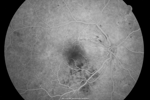 Hypertensive Retinopathy with Choroidal Ischemia Right Eye and Vision 8/200 - Blood Pressure 240/120 mmHg  IgA Nephropathy
39-year-old man two days ago he noticed poor vision in his right eye OD:  8/200;  OS:   20/20.   BP is 240/120
Keywords: cotton wool spot;serous retinal detachment;hypertensive;ischemia