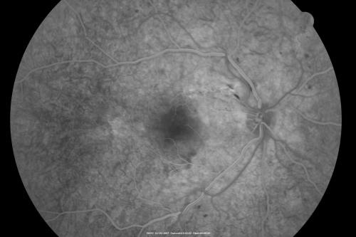 Hypertensive Retinopathy with Choroidal Ischemia Right Eye and Vision 8/200 - Blood Pressure 240/120 mmHg  IgA Nephropathy
39-year-old man two days ago he noticed poor vision in his right eye OD:  8/200;  OS:   20/20.   BP is 240/120
Keywords: cotton wool spot;serous retinal detachment;hypertensive;ischemia