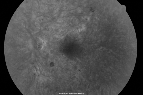 Hypertensive Retinopathy with Choroidal Ischemia Right Eye and Vision 8/200 - Blood Pressure 240/120 mmHg  IgA Nephropathy
39-year-old man two days ago he noticed poor vision in his right eye OD:  8/200;  OS:   20/20.   BP is 240/120
Keywords: cotton wool spot;serous retinal detachment;hypertensive;ischemia
