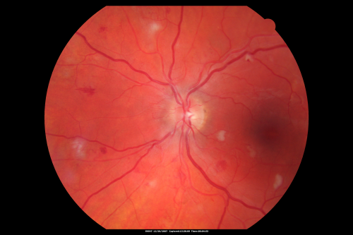 Hypertensive Retinopathy with Choroidal Ischemia Right Eye and Vision 8/200 - Blood Pressure 240/120 mmHg  IgA Nephropathy
39-year-old man two days ago he noticed poor vision in his right eye OD:  8/200;  OS:   20/20.   BP is 240/120
Keywords: cotton wool spot;serous retinal detachment;hypertensive;ischemia