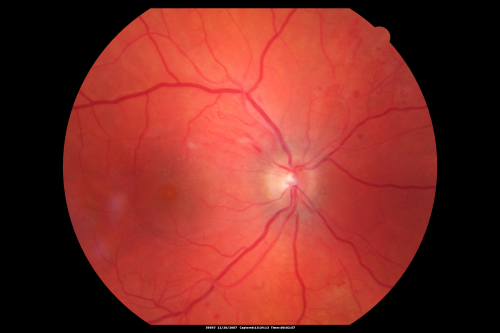 Hypertensive Retinopathy with Choroidal Ischemia Right Eye and Vision 8/200 - Blood Pressure 240/120 mmHg  IgA Nephropathy
39-year-old man two days ago he noticed poor vision in his right eye OD:  8/200;  OS:   20/20.   BP is 240/120
Keywords: cotton wool spot;serous retinal detachment;hypertensive;ischemia