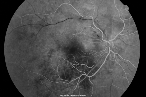 Hypertensive Retinopathy with Choroidal Ischemia Right Eye and Vision 8/200 - Blood Pressure 240/120 mmHg  IgA Nephropathy
39-year-old man two days ago he noticed poor vision in his right eye OD:  8/200;  OS:   20/20.   BP is 240/120
Keywords: cotton wool spot;serous retinal detachment;hypertensive;ischemia
