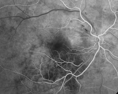 Hypertensive Retinopathy with Choroidal Ischemia Right Eye and Vision 8/200 - Blood Pressure 240/120 mmHg  IgA Nephropathy
39-year-old man two days ago he noticed poor vision in his right eye OD:  8/200;  OS:   20/20.   BP is 240/120
Schlüsselwörter: cotton wool spot;serous retinal detachment;hypertensive;ischemia