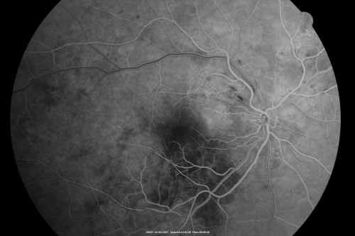 Hypertensive Retinopathy with Choroidal Ischemia Right Eye and Vision 8/200 - Blood Pressure 240/120 mmHg  IgA Nephropathy
39-year-old man two days ago he noticed poor vision in his right eye OD:  8/200;  OS:   20/20.   BP is 240/120
Keywords: cotton wool spot;serous retinal detachment;hypertensive;ischemia