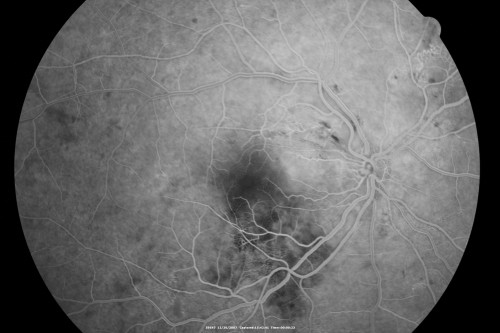 Hypertensive Retinopathy with Choroidal Ischemia Right Eye and Vision 8/200 - Blood Pressure 240/120 mmHg  IgA Nephropathy
39-year-old man two days ago he noticed poor vision in his right eye OD:  8/200;  OS:   20/20.   BP is 240/120
Keywords: cotton wool spot;serous retinal detachment;hypertensive;ischemia