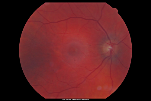 Hypertensive Retinopathy with Choroidal Ischemia Right Eye and Vision 8/200 - Blood Pressure 240/120 mmHg  IgA Nephropathy
39-year-old man two days ago he noticed poor vision in his right eye OD:  8/200;  OS:   20/20.   BP is 240/120
Keywords: cotton wool spot;serous retinal detachment;hypertensive;ischemia