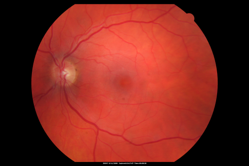 Hypertensive Retinopathy One Year later with good Vision   IgA Nephropathy
OD 20/30, OS 20/25 One year following initial episode.
