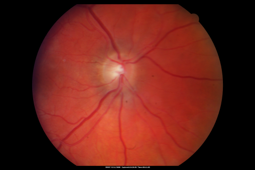 Hypertensive Retinopathy One Year later with good Vision   IgA Nephropathy
OD 20/30, OS 20/25 One year following initial episode.
