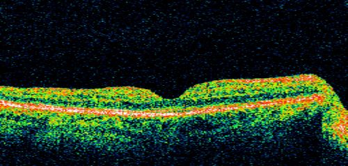 Hypertensive Retinopathy One Year later with good Vision  IgA Nephropathy
OD 20/30, OS 20/25 One year following initial episode.
