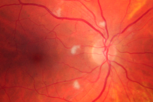 Malignant Hypertension - Cotton Wool Spots - Elschnig Spots - Optic Nerve Edema 
