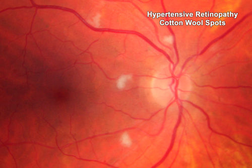 Malignant Hypertension - Cotton Wool Spots - Elschnig Spots - Optic Nerve Edema 
