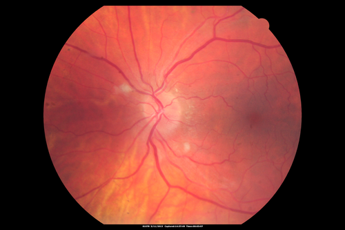 Malignant Hypertension - Cotton Wool Spots - Elschnig Spots - Optic Nerve Edema 
