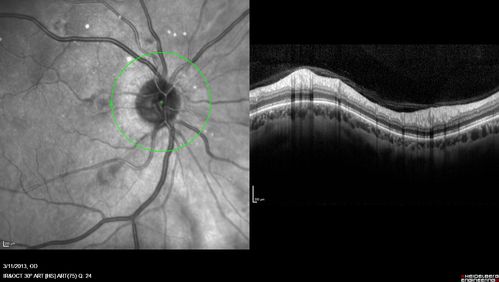Malignant Hypertension - Cotton Wool Spots - Elschnig Spots - Optic Nerve Edema 
