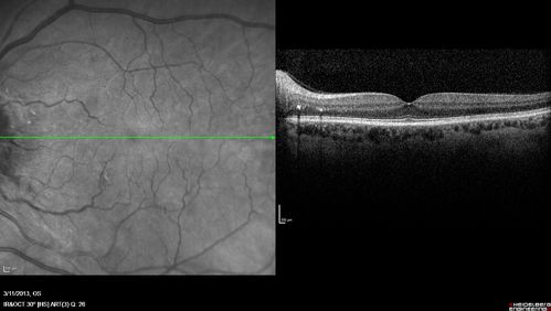 Malignant Hypertension - Cotton Wool Spots - Elschnig Spots - Optic Nerve Edema 
