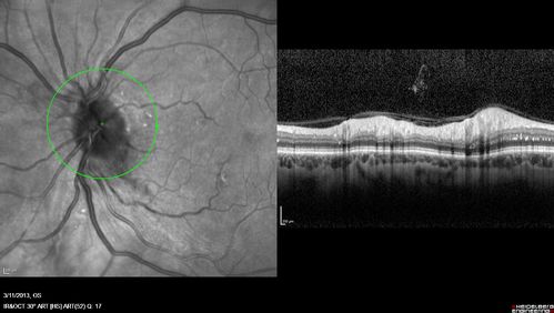 Malignant Hypertension - Cotton Wool Spots - Elschnig Spots - Optic Nerve Edema 
