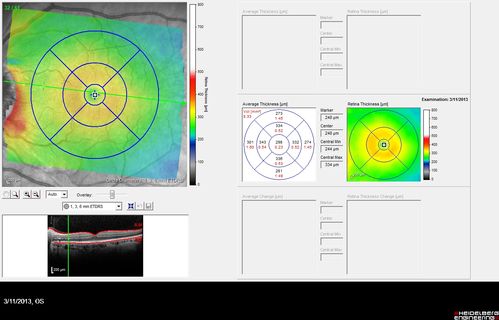 Malignant Hypertension - Cotton Wool Spots - Elschnig Spots - Optic Nerve Edema 
Macular Scan Shows Cotton Wool Spots and Nerve Swelling (on Left)
