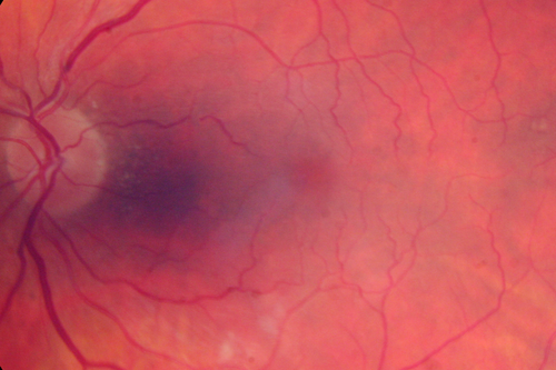 Malignant Hypertension - Cotton Wool Spots - Elschnig Spots - Optic Nerve Edema 
6 week fu - CWS are Fading
