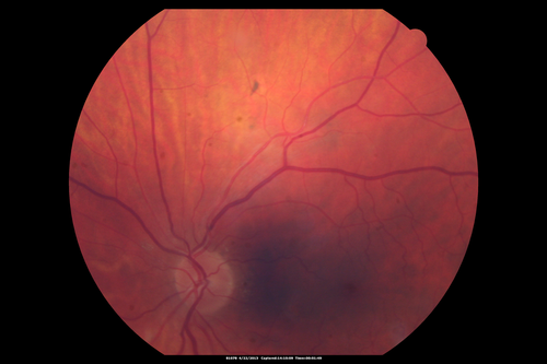 Malignant Hypertension - Cotton Wool Spots - Elschnig Spots - Optic Nerve Edema 
Elschnig Spots are pigment spots in periphery
