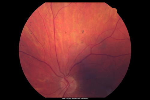 Malignant Hypertension - Cotton Wool Spots - Elschnig Spots - Optic Nerve Edema 
Elschnig Spots are pigment spots in periphery
