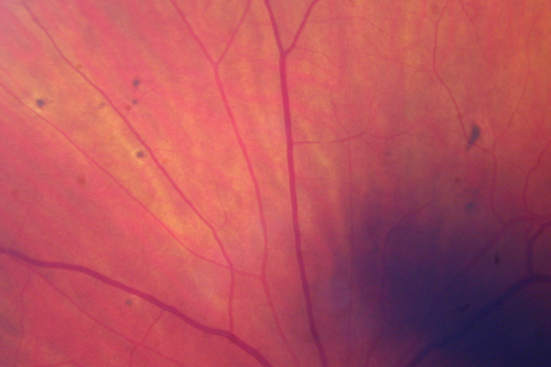 Malignant Hypertension - Cotton Wool Spots - Elschnig Spots - Optic Nerve Edema 
Elschnig Spots
