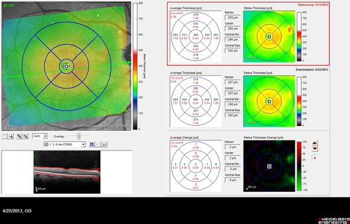 Malignant Hypertension - Cotton Wool Spots - Elschnig Spots - Optic Nerve Edema 
6 week fu - CWS are Fading
