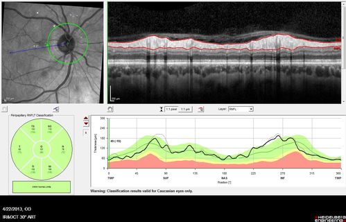 Malignant Hypertension - Cotton Wool Spots - Elschnig Spots - Optic Nerve Edema (NFL Scan - Black Line this visit, Gray line 6 weeks ago)
Nerve Swelling is Less
