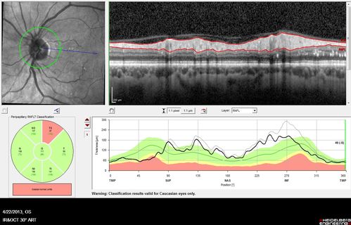Malignant Hypertension - Cotton Wool Spots - Elschnig Spots - Optic Nerve Edema 
Nerve Swelling is less
