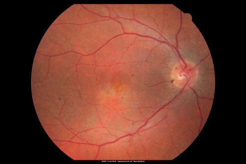 Hypertensive Choroidopathy - Pheochromocytoma - Chronic Very High Blood Pressure 49 YO Male
49-year-old man chronic very high blood pressure sometimes the blood pressure will go as high as 260/160, sometimes it is 200/120 and sometimes it is 160/80.  He has a pheochromocytoma on the adrenal gland and he has had vision loss in the right eye starting between three and four years ago.  

VISUAL ACUITY:  OD 20/60,  OS 20/25.
