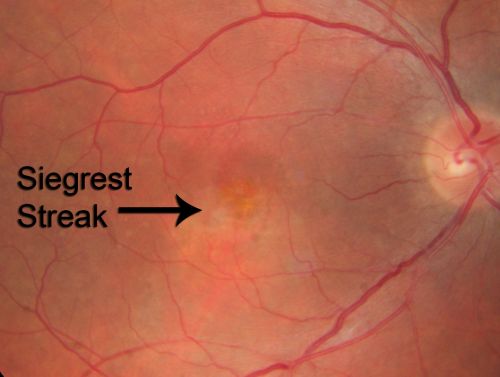 Hypertensive Choroidopathy - Pheochromocytoma - Chronic Very High Blood Pressure 49 YO Male
49-year-old man chronic very high blood pressure sometimes the blood pressure will go as high as 260/160, sometimes it is 200/120 and sometimes it is 160/80.  He has a pheochromocytoma on the adrenal gland and he has had vision loss in the right eye starting between three and four years ago.  

VISUAL ACUITY:  OD 20/60,  OS 20/25.
