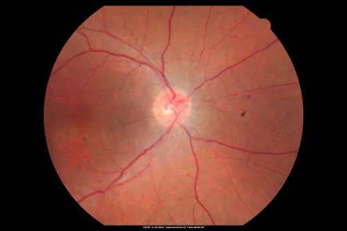 Hypertensive Choroidopathy - Pheochromocytoma - Chronic Very High Blood Pressure 49 YO Male
49-year-old man chronic very high blood pressure sometimes the blood pressure will go as high as 260/160, sometimes it is 200/120 and sometimes it is 160/80.  He has a pheochromocytoma on the adrenal gland and he has had vision loss in the right eye starting between three and four years ago.  

VISUAL ACUITY:  OD 20/60,  OS 20/25.
