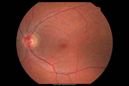 Hypertensive Choroidopathy - Pheochromocytoma - Chronic Very High Blood Pressure 49 YO Male
49-year-old man chronic very high blood pressure sometimes the blood pressure will go as high as 260/160, sometimes it is 200/120 and sometimes it is 160/80.  He has a pheochromocytoma on the adrenal gland and he has had vision loss in the right eye starting between three and four years ago.  

VISUAL ACUITY:  OD 20/60,  OS 20/25.
