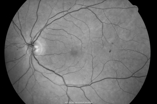 Hypertensive Choroidopathy - Pheochromocytoma - Chronic Very High Blood Pressure 49 YO Male
49-year-old man chronic very high blood pressure sometimes the blood pressure will go as high as 260/160, sometimes it is 200/120 and sometimes it is 160/80.  He has a pheochromocytoma on the adrenal gland and he has had vision loss in the right eye starting between three and four years ago.  

VISUAL ACUITY:  OD 20/60,  OS 20/25.
