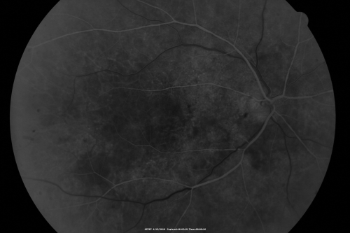 Hypertensive Choroidopathy - Pheochromocytoma - Chronic Very High Blood Pressure 49 YO Male
49-year-old man chronic very high blood pressure sometimes the blood pressure will go as high as 260/160, sometimes it is 200/120 and sometimes it is 160/80.  He has a pheochromocytoma on the adrenal gland and he has had vision loss in the right eye starting between three and four years ago.  

VISUAL ACUITY:  OD 20/60,  OS 20/25.
