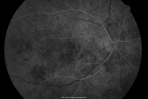 Hypertensive Choroidopathy - Pheochromocytoma - Chronic Very High Blood Pressure 49 YO Male
49-year-old man chronic very high blood pressure sometimes the blood pressure will go as high as 260/160, sometimes it is 200/120 and sometimes it is 160/80.  He has a pheochromocytoma on the adrenal gland and he has had vision loss in the right eye starting between three and four years ago.  

VISUAL ACUITY:  OD 20/60,  OS 20/25.

