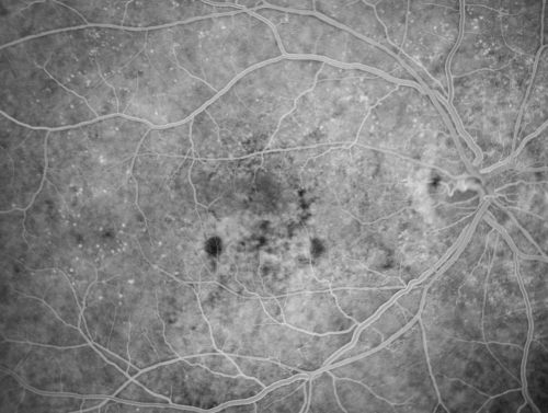 Hypertensive Choroidopathy - Pheochromocytoma - Chronic Very High Blood Pressure 49 YO Male
49-year-old man chronic very high blood pressure sometimes the blood pressure will go as high as 260/160, sometimes it is 200/120 and sometimes it is 160/80.  He has a pheochromocytoma on the adrenal gland and he has had vision loss in the right eye starting between three and four years ago.  

VISUAL ACUITY:  OD 20/60,  OS 20/25.
