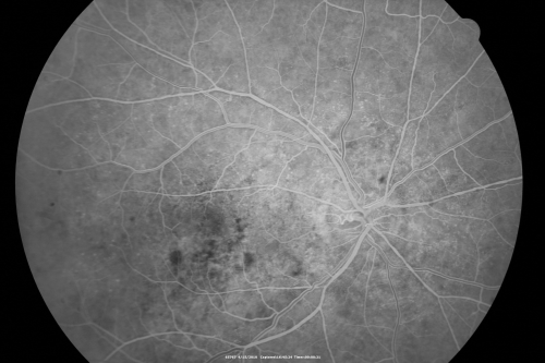 Hypertensive Choroidopathy - Pheochromocytoma - Chronic Very High Blood Pressure 49 YO Male
49-year-old man chronic very high blood pressure sometimes the blood pressure will go as high as 260/160, sometimes it is 200/120 and sometimes it is 160/80.  He has a pheochromocytoma on the adrenal gland and he has had vision loss in the right eye starting between three and four years ago.  

VISUAL ACUITY:  OD 20/60,  OS 20/25.
